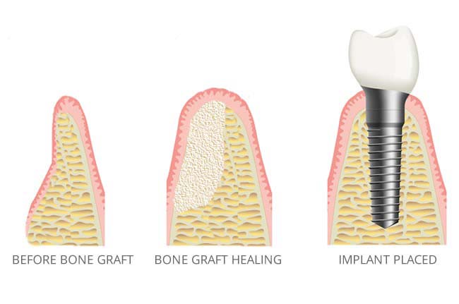 پیوند استخوان دندان 1 پیوند استخوان دندان در اراک توسط دکتر مبینا کمانی