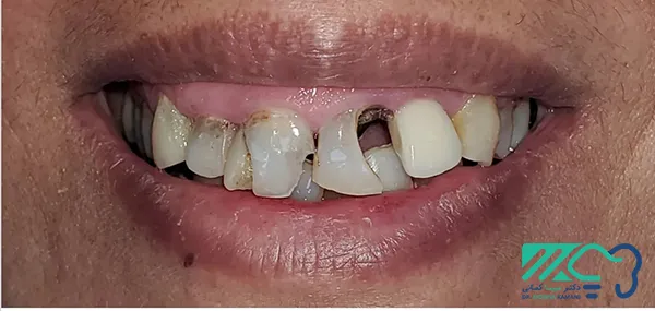 ایمپلنت دندان بدون درد 1 ایمپلنت بدون درد در اراک