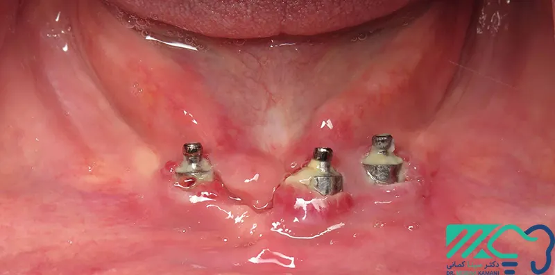 عفونت ایمپلنت دندان: پیشگیری، تشخیص و درمان 1 عفونت ایمپلنت دندان
