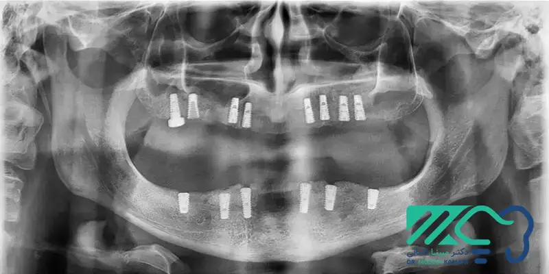 ایمپلنت اقساطی در اراک 1404+طرف قرارداد با بیمه 7 ایمپلنت اقساطی و ایمپلنت با بیمه